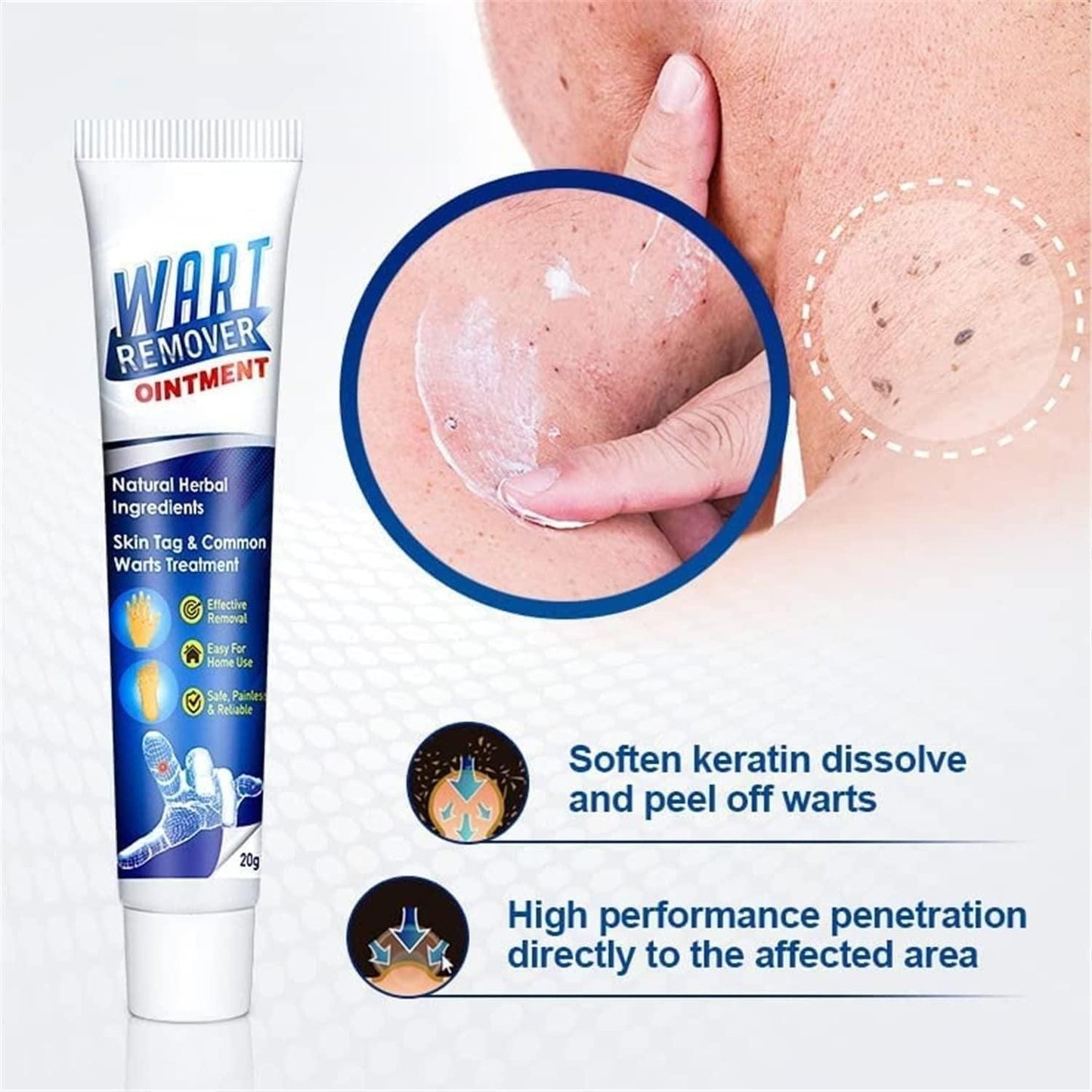 Wart Remover (Buy 1, Get 1 Free)